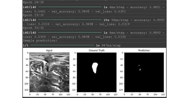 Real-Time Ultrasound Nerve Segmentation using U-Net