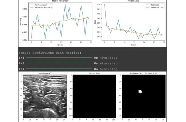 Real-Time Ultrasound Nerve Segmentation using U-Net